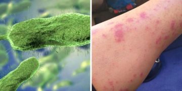 La bacteria Vibrio Vulnificus, También Conocida como la “Bacteria Come Carne” Conoce como la Puedes Adquirir