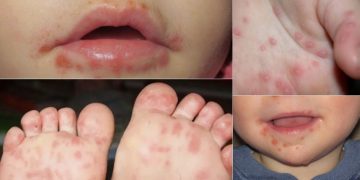 La Enfermedad de Manos, Pies y Boca: No es Grave, Pero Sí Necesita Nuestra Atención