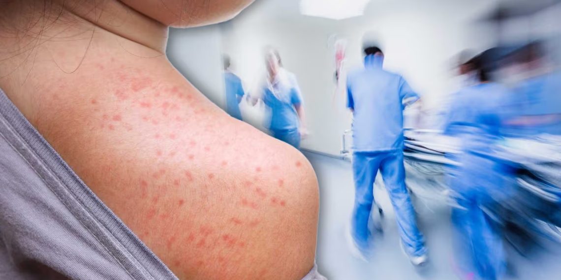 El Sarampión no es un recuerdo: El reto de no bajar la guardia