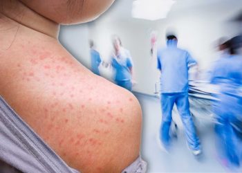 El Sarampión no es un recuerdo: El reto de no bajar la guardia